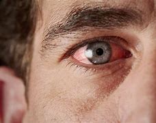 Image result for Eyes Red and Itchy