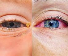 Image result for Pink Eye or Allergies