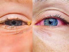 Image result for Itchy Eyes Allergies