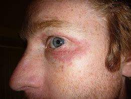 Image result for Allergic Rash around Eyes