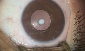 Image result for Juvenile Cataract