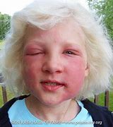 Image result for Poison Ivy Rash On Face