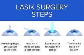 Image result for Lasik