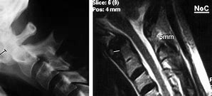 Image result for Subluxation X-ray