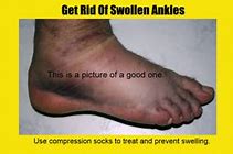 Image result for Swollen Ankles Red Rash