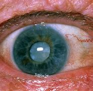 Image result for Cataract Inside Eye