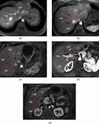 Image result for Liver MRI Anatomy