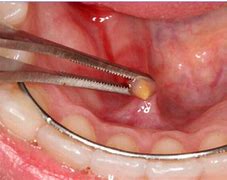 Image result for Sublingual Salivary Gland Duct