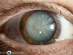 Image result for Juvenile Cataract