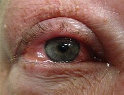 Image result for Pink Eye or Allergies