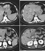 Image result for Liver MRI Anatomy