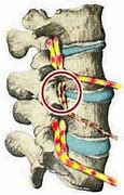 Image result for Subluxación Vertebral