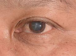 Image result for Diabetic Cataract