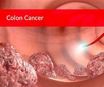 Image result for Human Body Colon Cancer