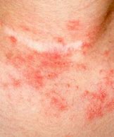 Image result for Eczema Treatments Adults