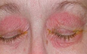 Image result for Allergic Rash around Eyes