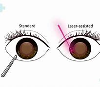 Image result for Femto Cataract Surgery