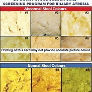 Image result for Acholic Stool Chart