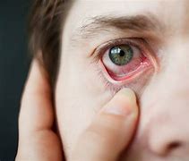 Image result for Itchy Eyes Allergies