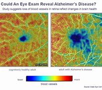 Image result for Alzheimer's Disease Chart