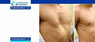 Image result for Rib Cage Deformities