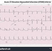 Image result for 12 Lead EKG Clip Art