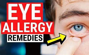 Image result for Itchy Eyes Allergies