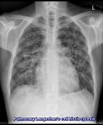 Image result for Pulmonary Langerhans Cell Histiocytosis