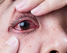 Image result for Eyes Red and Itchy