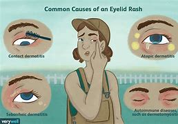 Image result for Allergic Rash around Eyes