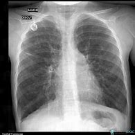 Image result for Pulmonary Langerhans Cell Histiocytosis