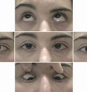 Image result for Disconjugate Eye Movement