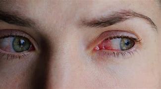 Image result for Pink Eye or Allergies