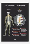 Image result for Subluxation Complex