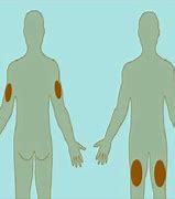 Image result for Intradermal Injection Sites Diagram