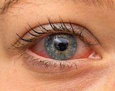 Image result for Eyes Red and Itchy