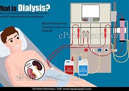 Image result for How Does Dialysis Work