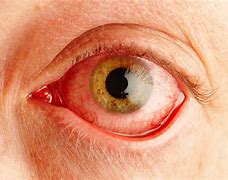 Image result for Itchy Eyes Type