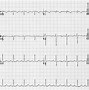 Image result for SVT Rhythm EKG