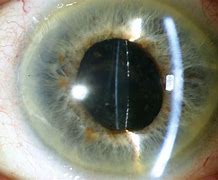 Image result for Second Cataract