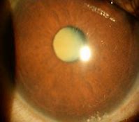 Image result for Secondary Cataract