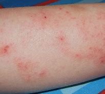 Image result for Eczema Treatments Adults