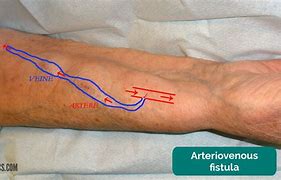 Image result for AV Fistula Dialysis