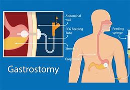 Image result for Enteral Route of Administration