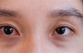 Image result for Pink Eye or Allergies