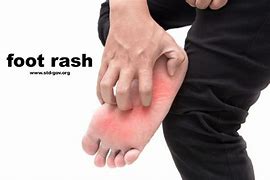 Image result for Rash On Foot and Ankle