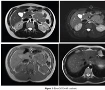 Image result for Liver MRI Anatomy