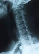 Image result for Subluxation X-ray