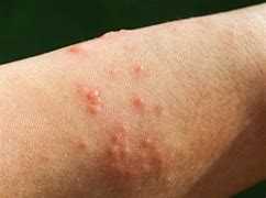 Image result for Poison Ivy Symptoms