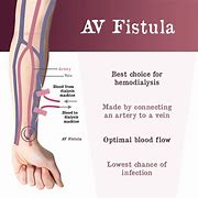 Image result for AV Fistula Dialysis